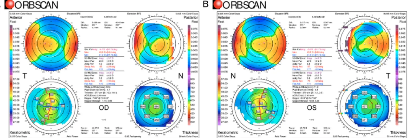 Figure 1. Topographic and tomographic findings of the patient after hyperopic laser-assisted in-situ keratomileusis (LASIK) using  Orbscan II
