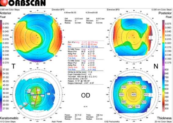 Figure 2. Postoperative findings of Orbscan. Central cornea has been flattened after laser refractive surgery