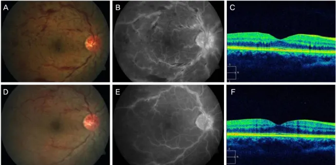Figure 2. Color fundus photograph, fluorescein angiography (FAG), and optical coherence tomography (OCT) from right eye of a  22-year-old man with central retinal vein occlusion and transient decrease in Protein C antigen