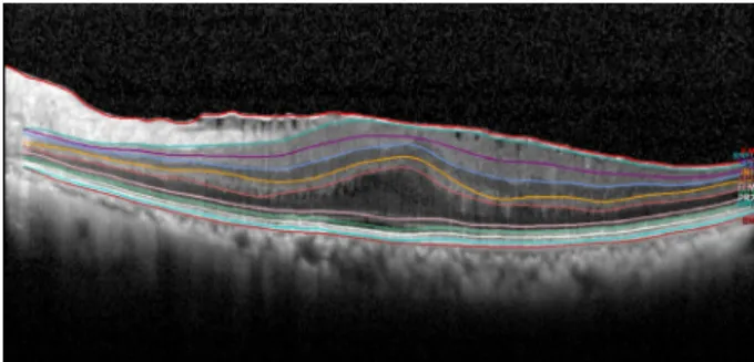 Figure 1. Representative image of retinal layer division de- de-termined by the new segmentation application of the spectralis  optical coherence tomography in epiretinal membrane  (Segmentation Technology; Heidelberg Engineering, Inc.,  Heidelberg, German