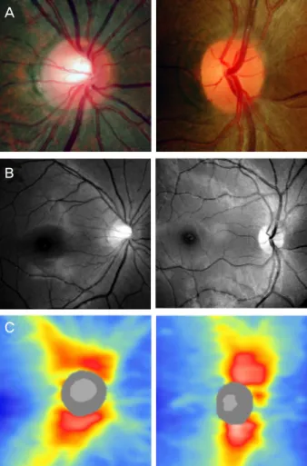 Figure 1. An example of optic disc in a healthy eye (left col- umn) and an eye with situs inversus of optic disc (right  col-umn)