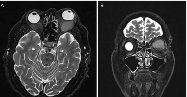 Figure 1. Magnetic resonance image of the patient (A: axial, B: coronal). Moderate to high intensity intraconal mass with irregular  margin was observed in T2 image.