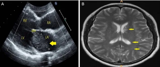 Figure 2. Echocardiographic and brain magnetic resonance imaging findings. (A) Transthoracic echocardiographic finding