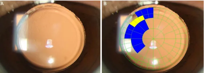Figure 1. Posterior capsule opacification (PCO) severity grading with POCOman software
