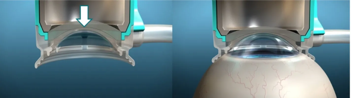 Figure 1. Advantages of SoftFit TM  patient interface. In contrast to solid direct patient interface, the design of the new hydrogel  SoftFit™ interface (white arrow) has an extended suction ring skirt that allows the natural curvature of the cornea and de