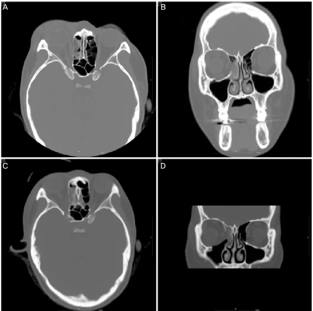 Figure 2. Orbital Computed tomography of the patient. Orbital Computed tomography of preoperative combined medial and inferior  orbital wall fracture