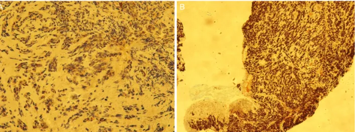 Figure 3. Overview dissection of biopsy of eyelid mass. Epithelioid cell proliferation and positive staining of (A) GCDFP-15 and (B)  GATA-3 was seen, suggestive of breast origin metastatic carcinoma (A: GDCFP-15, ×40) (B: GATA-3, ×10).