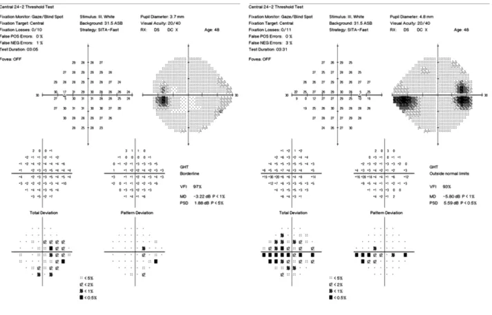 Figure 1. Humphrey visual field on the initial examination. The Blind spot was enlarged and a scotoma was noticeable in the nasal  visual field of the right eye