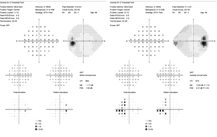 Figure 4. Humphrey visual field on the visit two months later. The Blind spot and the scotoma on the nasal field of the right eye  decreased