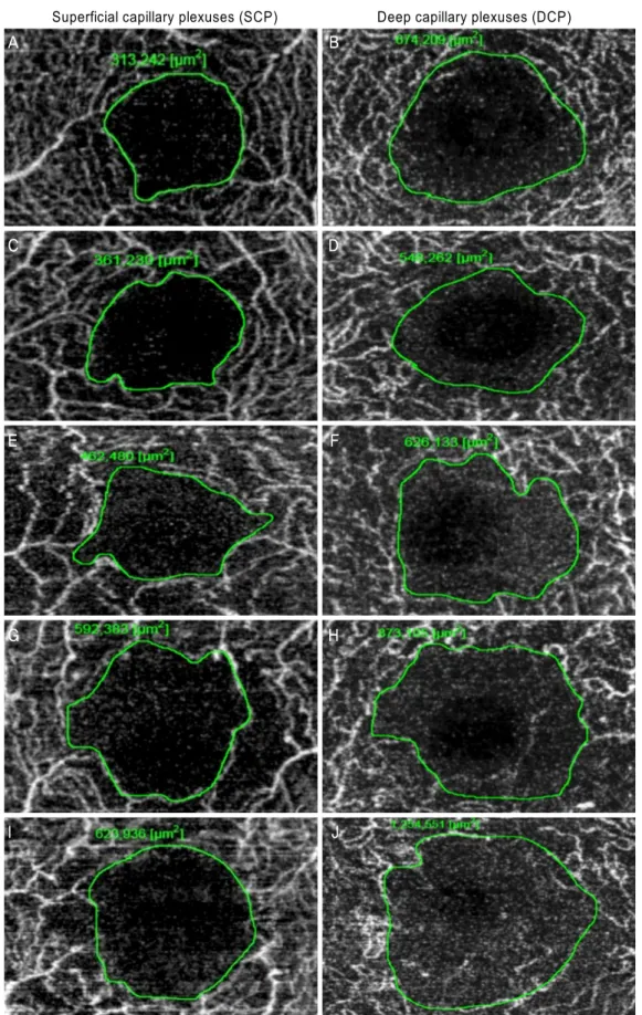 Figure 2. Manual drawing of the foveal avascular zone (FAZ) boundary. (A, B) FAZ of the SCP and DCP in no diabetic retinopathy  patients