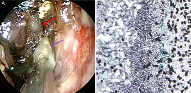 Figure 4. Nasal endoscopic photograph of the left nasal cavity and histopathological finding of postoperative specimen