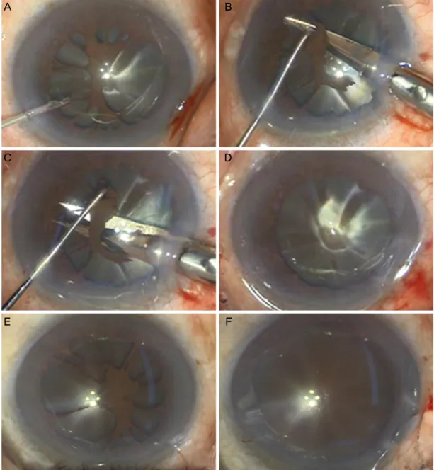 Figure 2. Anterior segment structures as seen under operating microscope showing surgical steps in both eyes