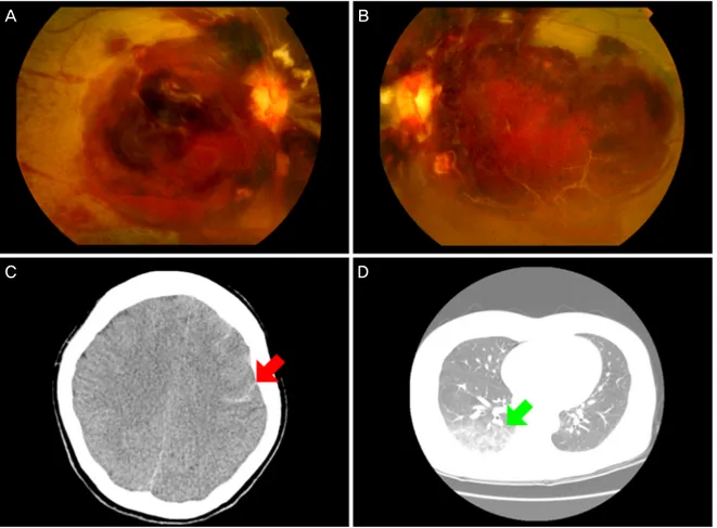 Figure 1. Case 1. (A, B) Fundus photography showed extensive retinal, preretinal, and vitreous hemorrhage in both eyes
