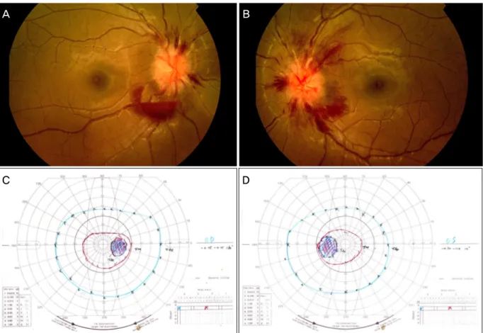 Figure 3. Case 2. (A, B) Fundus photography showed papilledema, retinal hemorrhage, and preretinal hemorrhage