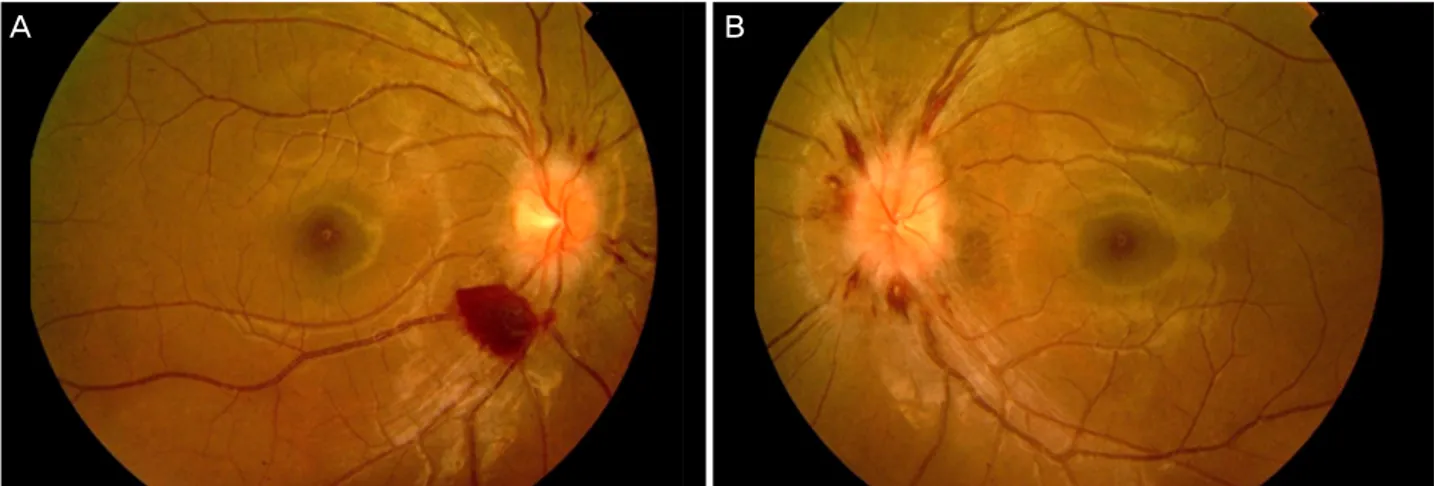 Figure 4. One month later in case 2. (A, B) Fundus photography showed that papilledema, retinal hemorrhage, and preretinal hem- hem-orrhage were diminished in both eyes.