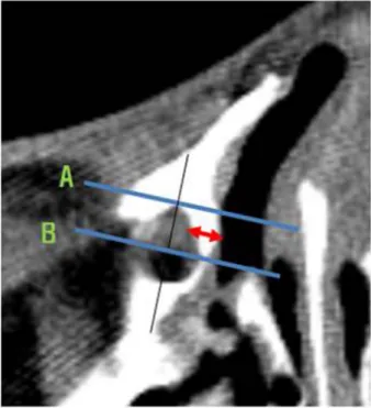 Figure 1. Measurement of the thickness of the maxillary fron- fron-tal process by computed tomography scan