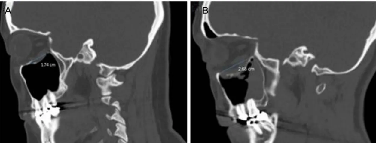 Figure 2. Three-dimensional computed tomography scan of the orbits (sagittal view). (A) Fracture size <2 cm