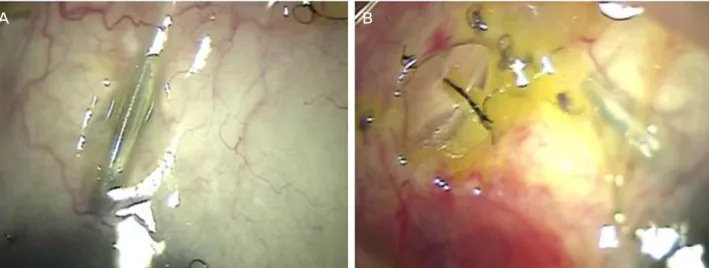 Figure 3. Four months after Ahmed valve implantation using a synthetic dura substitute in case 3