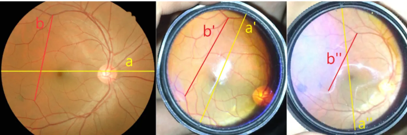 Figure 2. Examples of range measurement of retinal examination. The photographing range was compared with the b/a value of each  photograph