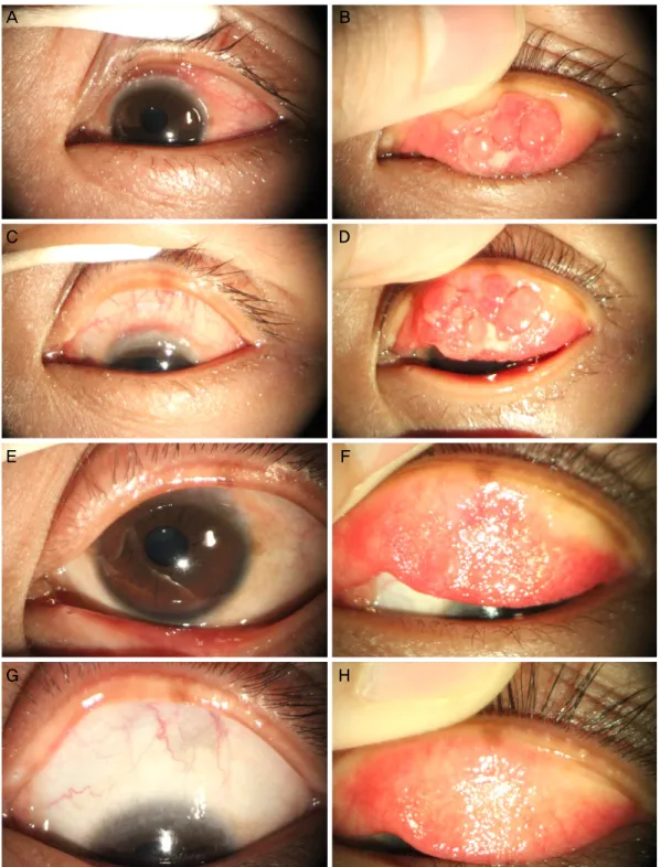 Figure 1. Slit lamp photographs of the left eye. (A, B) At the initial presentation, there were superior limbal nodules and superior tar- tar-sal papillae