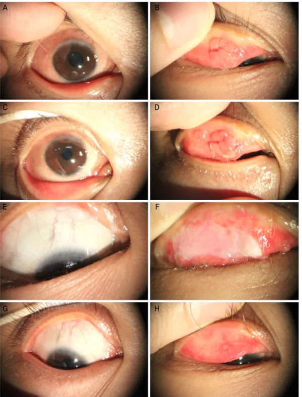Figure 2. Slit lamp photographs of the right eye. (A, B) At the initial presentation, there were superior limbal nodules and superior  tarsal papillae
