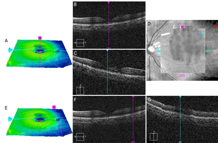 Figure 3. Cirrus HD-OCT of the left eye. (A) Retinal thickness map from the Macular Cube 512 × 128 volume scan on Cirrus  HD-OCT