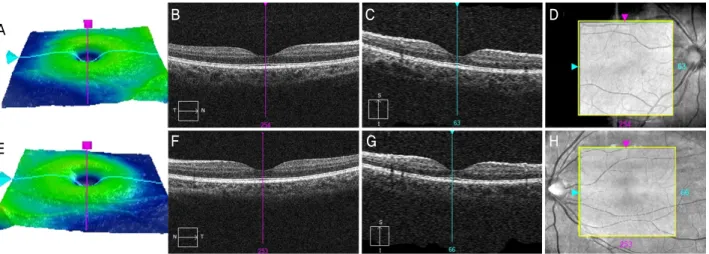 Figure 4. Cirrus HD-OCT of the both eyes two weeks after the first visit. (A-D) Macular Cube 512 × 128 volume scan on Cirrus  HD-OCT of the right eye