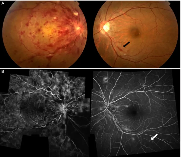 Figure 2. A case of central retinal vein occlusion (CRVO) in the right eye (Patient No
