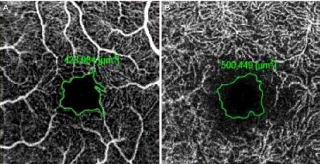 Figure 1. Manual outlining (green) of the border of foveal avascular zone. Optical coherence tomography angiography 3 × 3 mm  scans segmented at the superficial capillary plexus (A) and the deep capillary plexus (B)