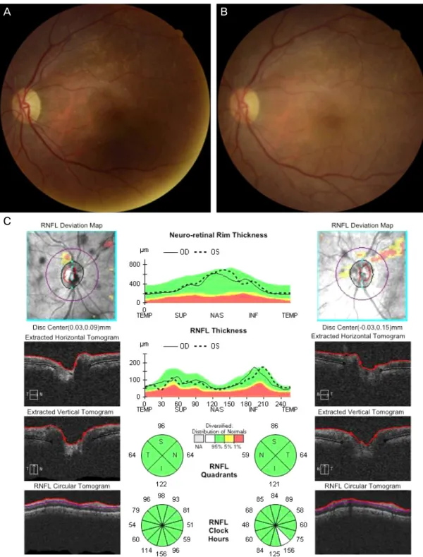 Figure 3. Fundus photographs and optical coherence tomography (OCT) image of the patient