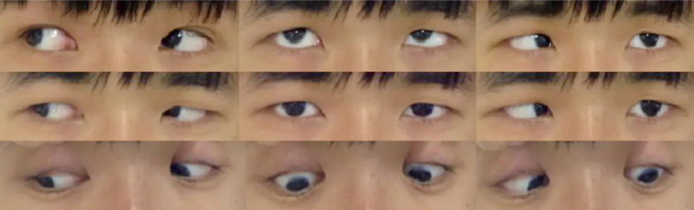 Figure 1. Gaze photographs 1 week after the initial presentation. After 1 week, there was esodeviation with abduction limitation in  the left eye