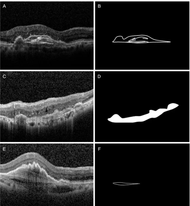 Figure 1. Representative images of morphologic features of spectral-domain optical coherence tomography (SD-OCT) related to  age-related macular degeneration
