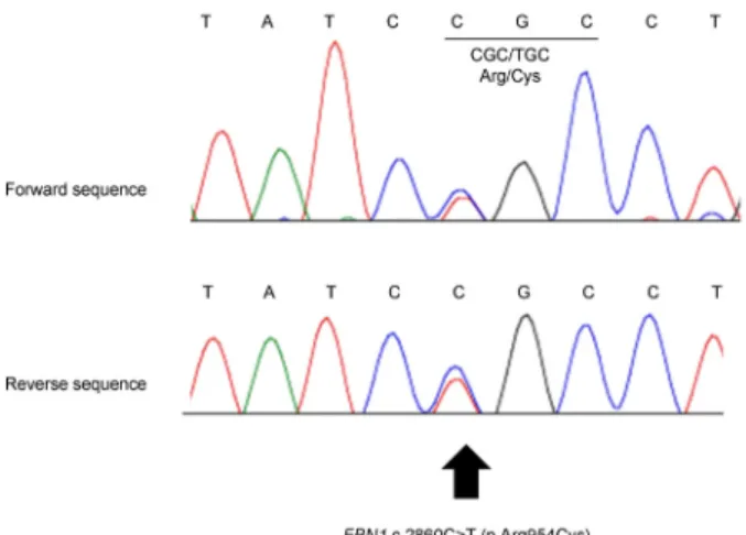 Figure 4. Sequencing analysis of FBN1 gene for the proband  identified the c.2860C>T (p.Arg954Cys) pathogenic variant  (arrow)