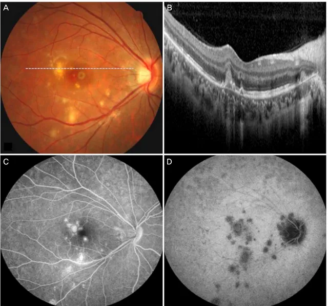 Figure 1. Fundus photograph, optical coherence tomography (OCT), fluorescein angiography and indocyanine green angiography at  initial visit