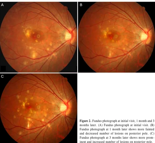 Figure 2. Fundus photograph at initial visit, 1 month and 3 months later. (A) Fundus photograph at initial visit