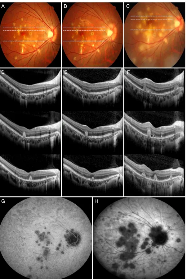 Figure 3. Fundus photograph, optical coherence tomography (OCT) and indocyanine green angiography at dexamethasone implant  injection, 2 months and 3 months after implant injection