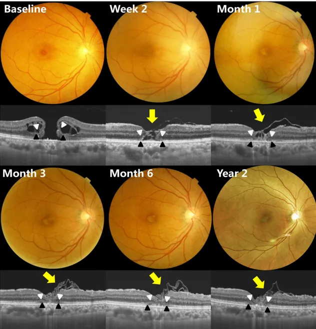 Figure 1. A Case of 67-year-old woman with full thickness macular hole. Two weeks after autologous internal limiting membrane  transplantation, optical coherence tomography images showed a glial tissues in the fovea without a complete hole closure