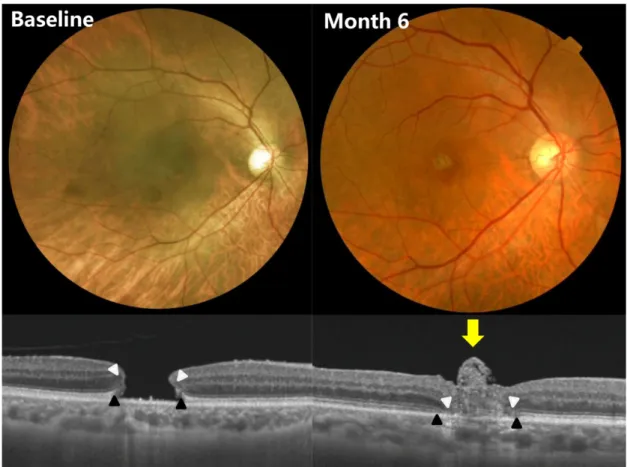 Figure 2. A case of 70-year-old woman with full thickness macular hole. One month after autologous internal limiting membrane  transplantation, the closure of the hole and glial tissues in fovea (yellow arrow) were observed in optical coherence tomography