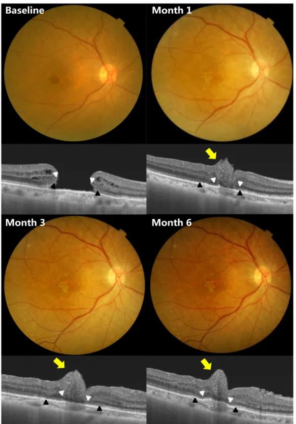 Figure 3. A case of 75-year-old woman with full thickness macular hole. One month after autologous internal limiting membrane  transplantation, irregular contour of fovea (yellow arrows) was detected in optical coherence tomography