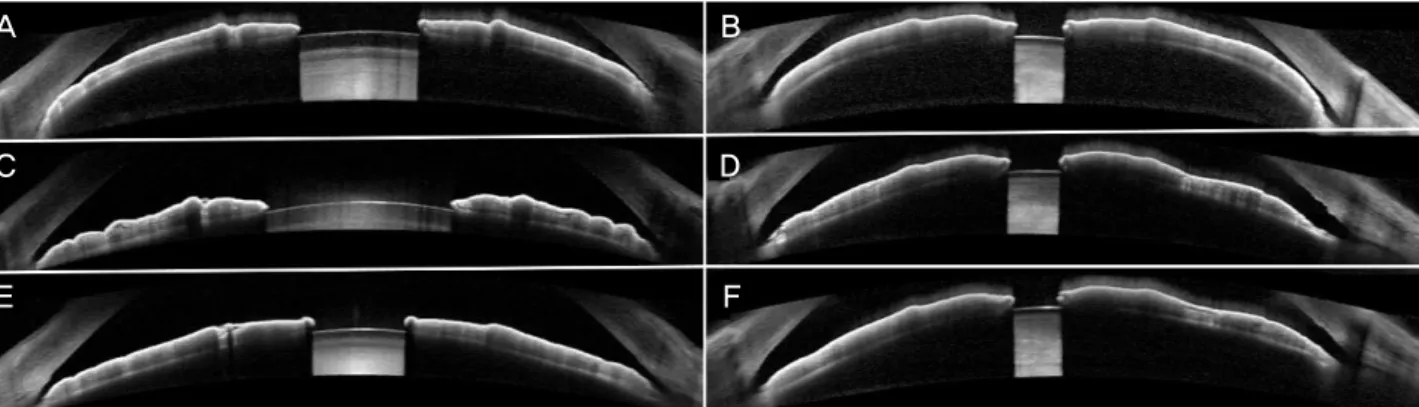 Figure 3. Laser peripheral iridotomy (LPI) in patient with acute angle closure crisis (AACC)