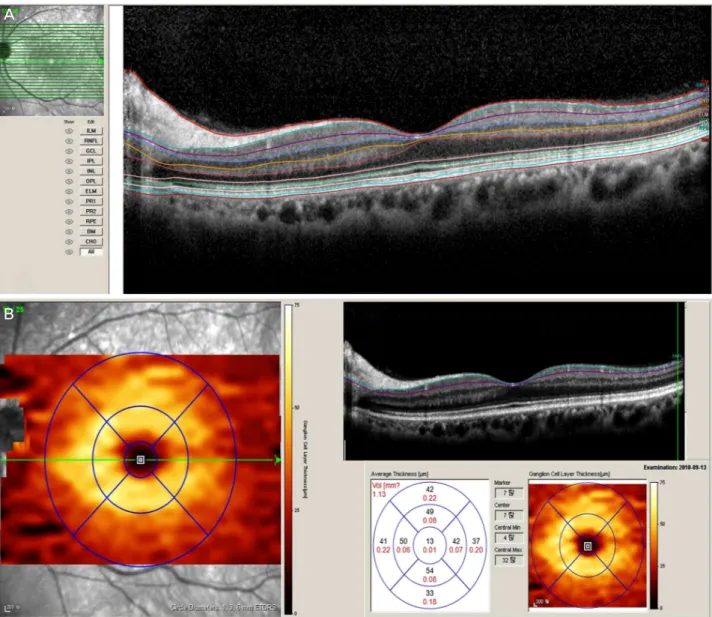 Figure 1. Automatic segmentation of retina by SD-OCT. (A) Segmentation editor view of retina by SD-OCT Spectralis software ver- ver-sion 0.6