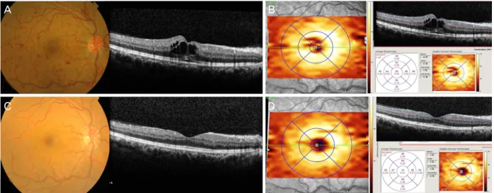 Figure 3. Changes in GCL thickness after multiple anti-VEGF injections in CRVO. Right eye of a 54-year-old man with CRVO
