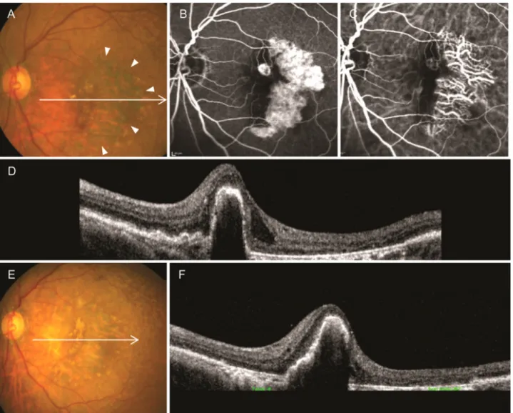 Figure 1. Fundus photography, fluorescein angiography, indicyanine-green angiography, and optical coherence tomography find- find-ings in a 72-year-old patient with retinal angiomatous proliferation