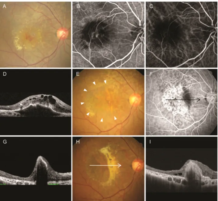 Figure 2. Fundus photography, fluorescein angiography, indicyanine-green angiography, and optical coherence tomography find- find-ings in a 71-year-old patient with retinal angiomatous proliferation
