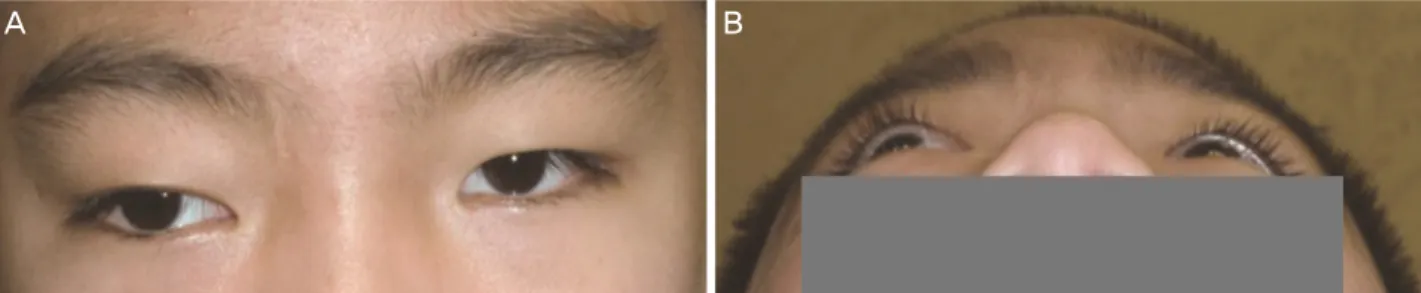 Figure 1. Clinical photographs of the patients eyelids. The photographs shows hypoglobus (A) and exophthalmos (B) of the right  eye.