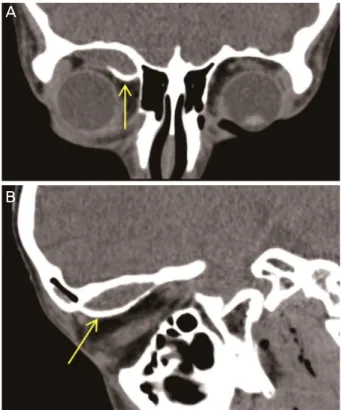 Figure 3. Orbit CT taken at 2 weeks after trauma. Convex-shap- Convex-shap-ed mass lesion with fine spots of calcifications at the superior  or-bit (arrow)