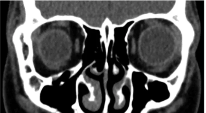 Figure 6. Orbit CT scan taken at 1month after surgery. 