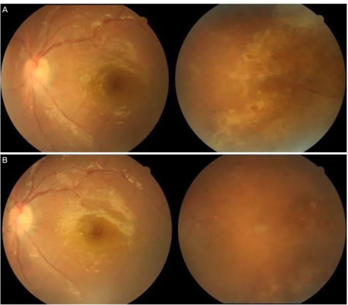 Figure 3. After a sample of aqueous humor was obtained by  anterior chamber paracentesis, PCR analysis was performed