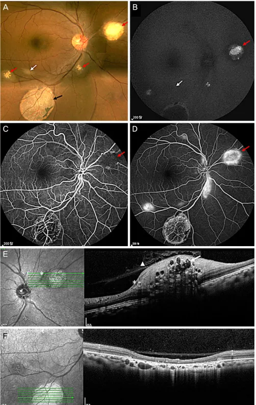 Figure 3. Case 3. (A) Fundus photography shows multiple retinal hamartomas with calcified nodular central core surrounded by a  relatively flat, smooth-surfaced, semitransparent periphery (red arrows) and faint semi-translucent lesion (white arrow)