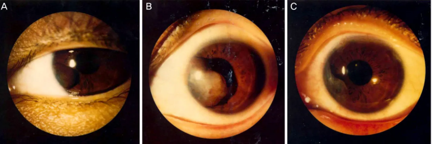 Figure 1. Treatment of primary iris cyst with endodiathermy. (A) A primary iris cyst was discovered in September 1996